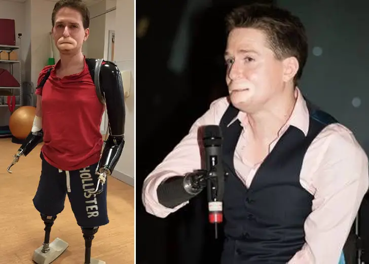 Alex Lewis Lost His Lips And Fought Death Due To Sepsis, But Got Family Support