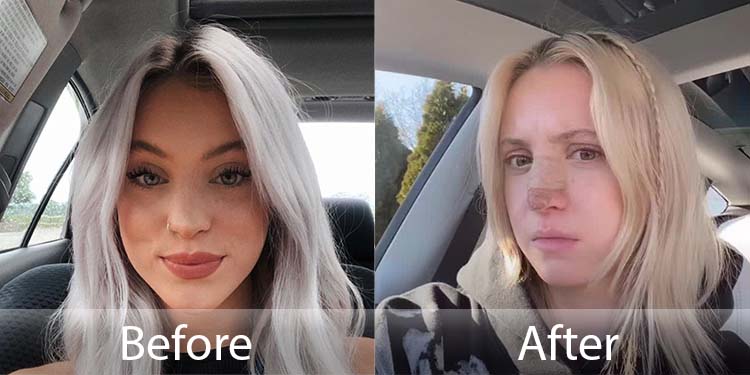 Riley Hubatka Gets Plastic Surgery To Fix Her Broken Nose