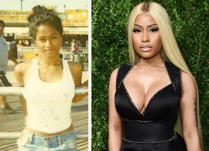 Nicki Minajs Before Surgery And After Pictures 